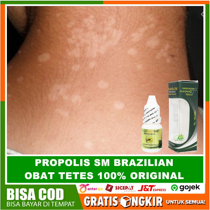 Obat Tetes Penghilang Panu / Hapur Menahun, Jamur Kulit Membandel, Di Wajah - Propolis SM