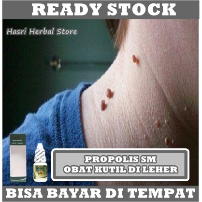 Obat Untuk Kutil - Obat Tetes Hancurkan Kutil - Daging Jadi - Penghilang Keloid - Obat Hilangkan Kutil Papiloma - Perontok Papiloma - Penghancur Skin Tag - Kutil Dileher - Punggung - Tangan - Propolis SM Brazil