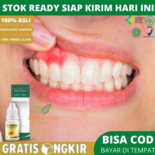 Obat Gusi Bengkak dan Sakit Gigi, Obat Gusi Berdarah, Obat Gusi Bernanah, Obat Pengempis Gusi Bengka