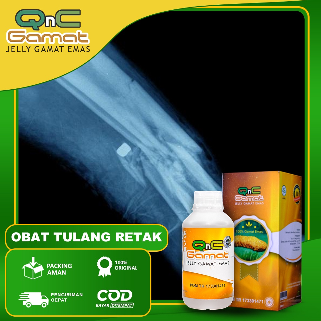 Obat Tulang Retak Patah Tulang