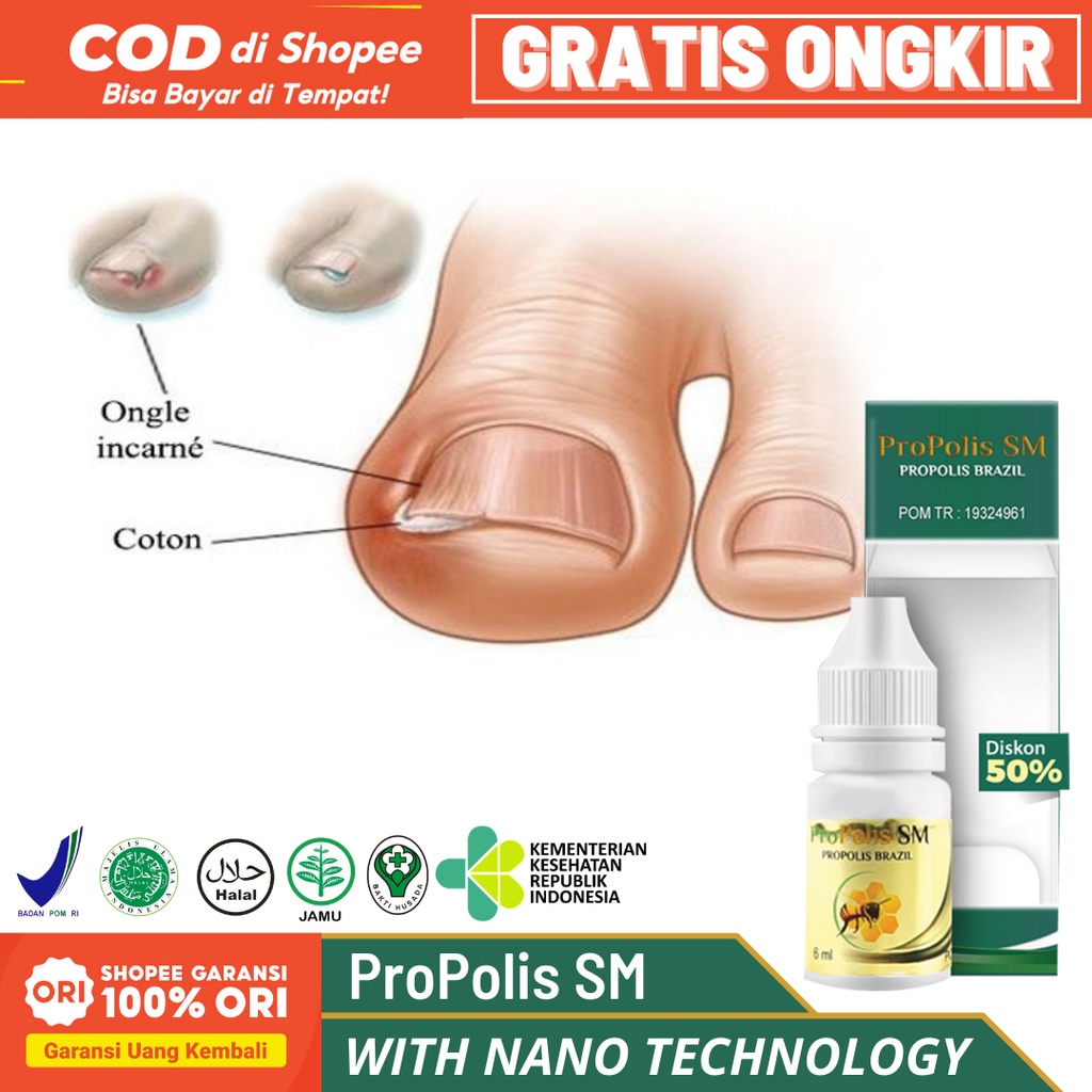 Obat Cantengan Di Jempol Kaki Cantengan Parah Cantengan Bernanah Jempol Kaki Bengkak - ProPolis SM B