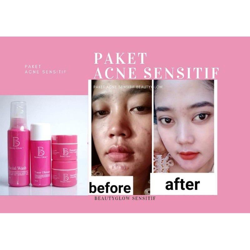 BG skin acne sensitif