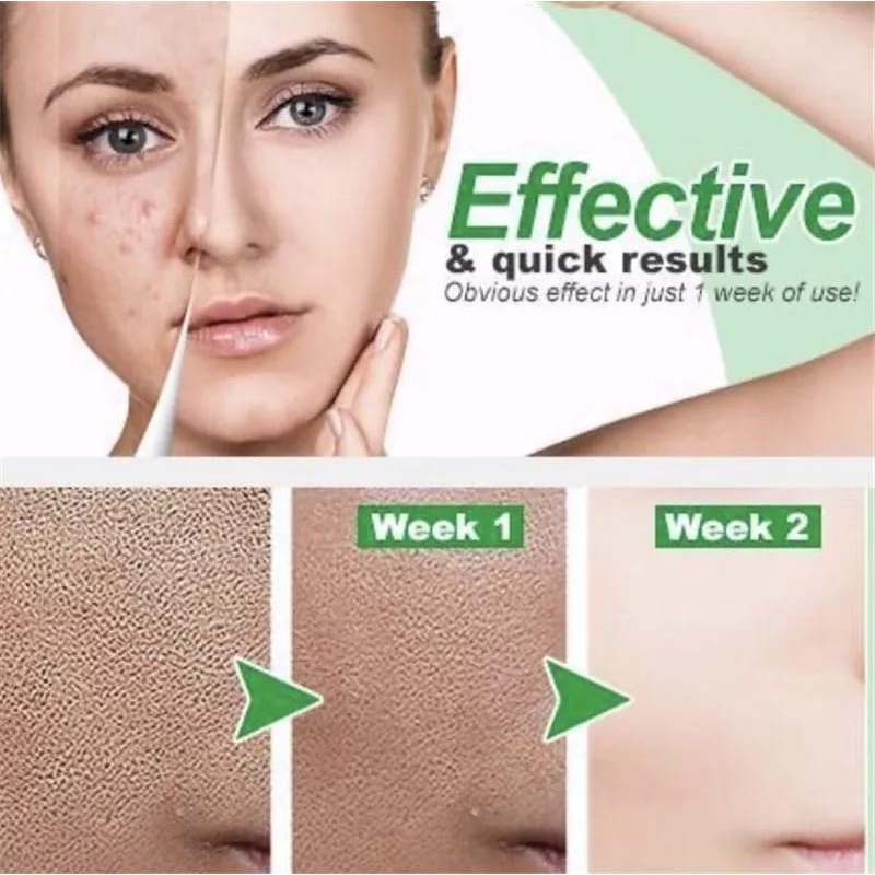 Nicotinamide Whitening Serum Freckles Remove Dark Spots SERUM ANTI AGING ORIGINAL | SERUM ANTI PENUAAN VIRAL