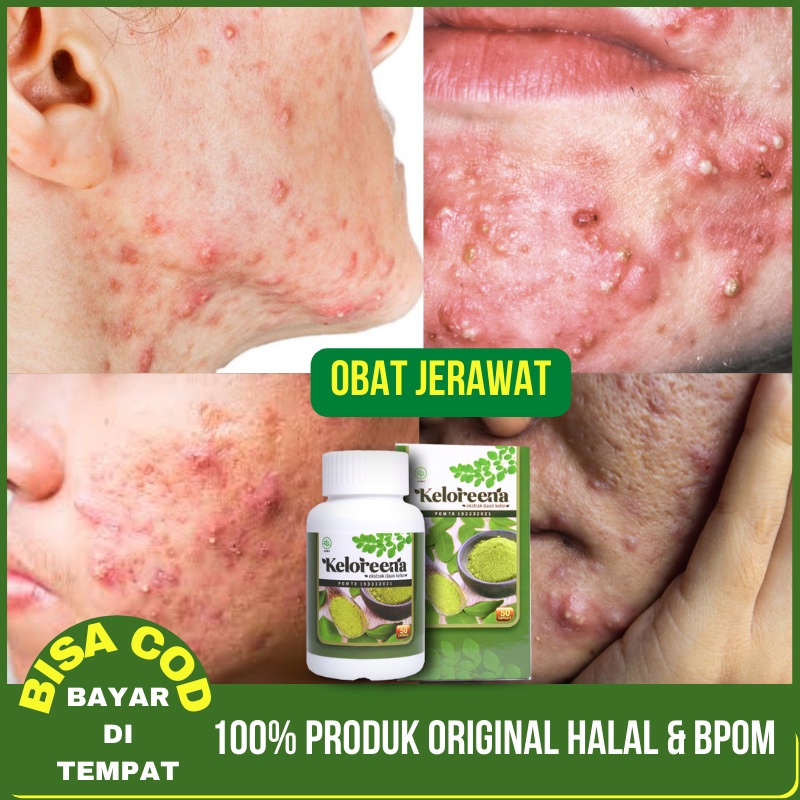 Obat Jerawat, Bekas Jerawat, Jerawat Punggung, Jerawat Batu, Jerawatan, Pria dan Wanita Keloreena Es