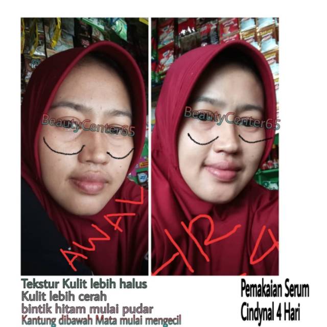 Serum PENGHILANG Flek & Jerawat Bukan Implora Bioaqua Mimi white