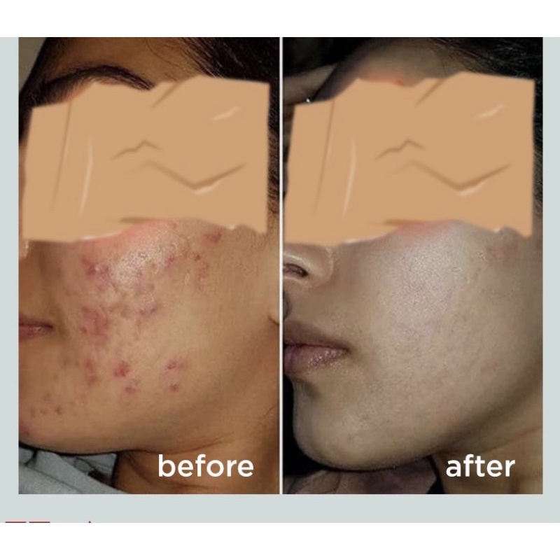 ACNE GLOWING FAILA PUTRI/Night Cream for lightening Acne FP BPOM / krim malam jerawat