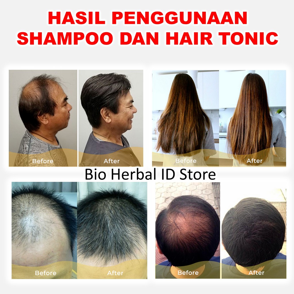 Image of Shampoo Anti Rontok Obat Ketombe Dan Rambut Rontok Hair Loss Shampoo B1B #4