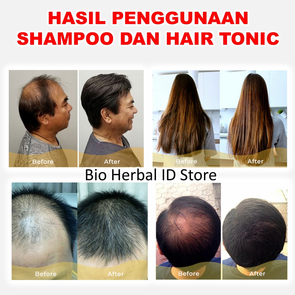 Sampo Rontok Obat Ketombe Dan Rambut Rontok Hair Loss Shampoo B1C-4