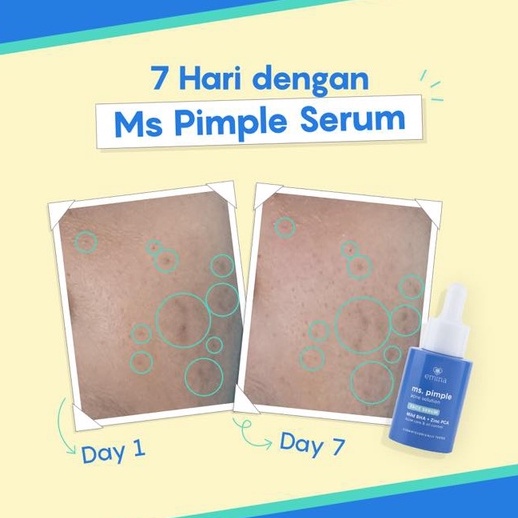 Emina Ms Pimple Acne Face Serum