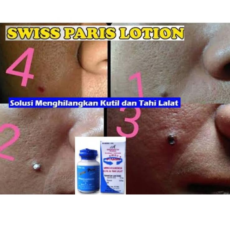 Swiss Paris Penghilang Tahi Lalat Dan Kutil Ampuh Tanpa Operasi Aman  Kutil  Tahi Lalat ✔ R8J