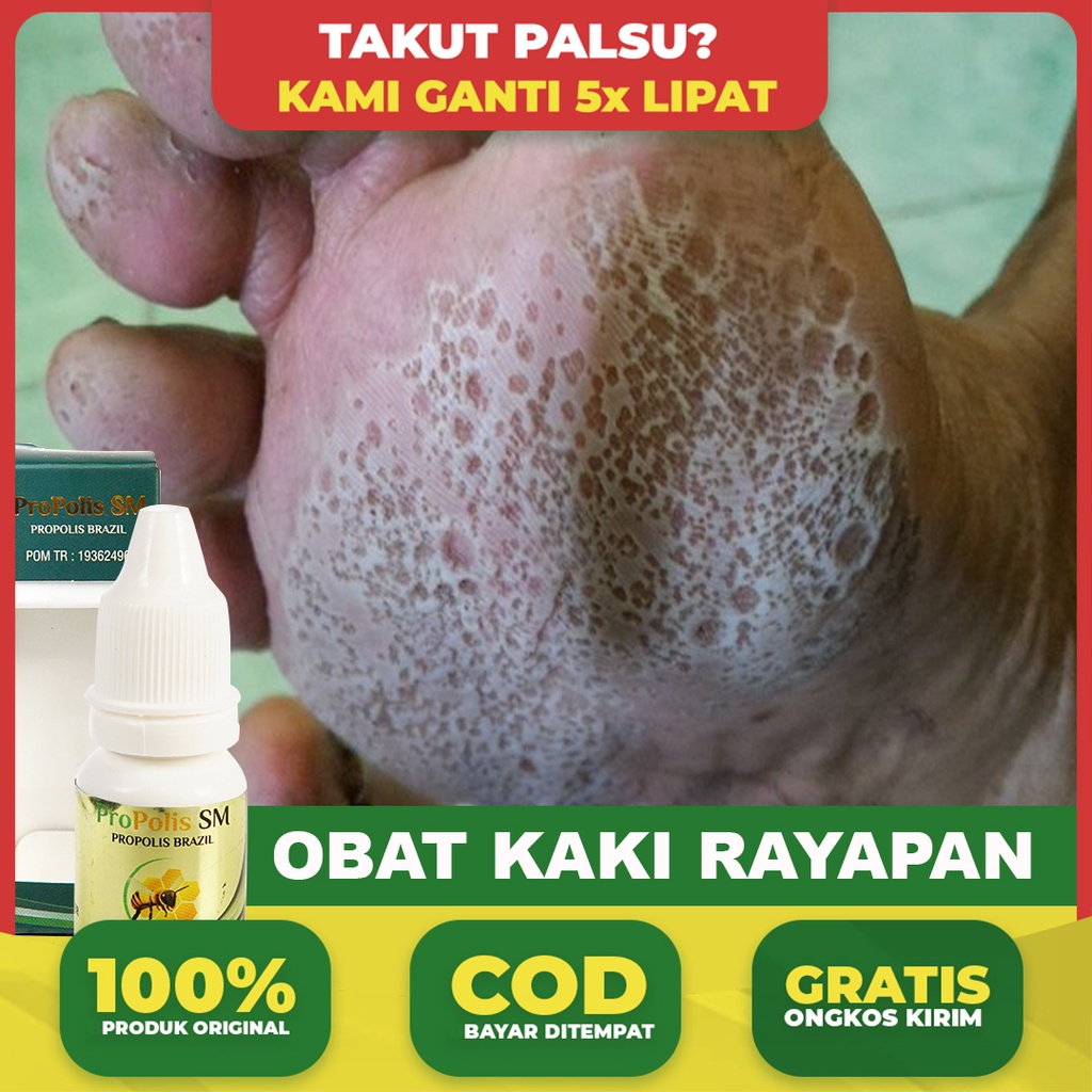 Obat Kaki Rayapan dan Bau - Telapak Kaki Berlubang Kecil Kecil - Kaki Pecah Pecah - Atasi Dengan Pro