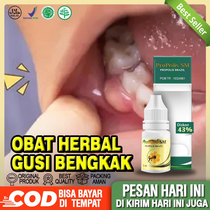 Obat Gusi Bengkak, Obat Herbal Gusi Bengkak, Obat Herbal Gusi Bengkak Bernanah, Obat Untuk Gusi Beng
