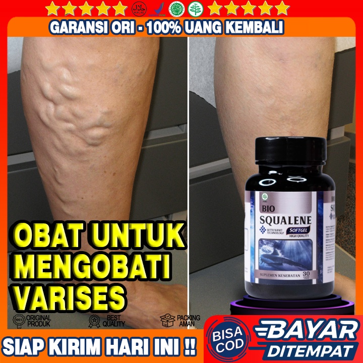 Obat Verises - Obat Varises Di Kaki - Obat Varises Di Betis - Obat Varises Di Betis Kaki  - Obat Ura