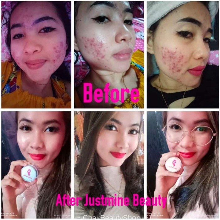 justmine acne /justmine jelly acne justmine skincare / justmine beauty safa