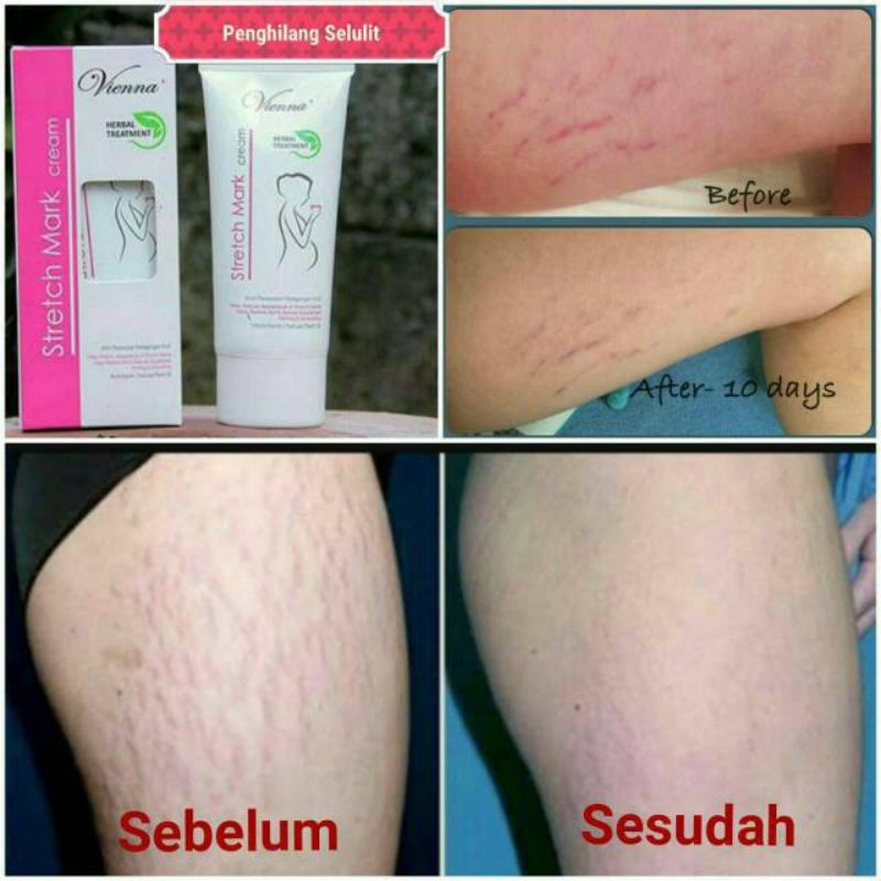 [rumahbayipdg] Vienna cream ORIGINAL penghilang Stretch Mark/Garis perut /selulit