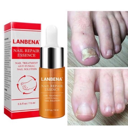 LANBENA NAIL REPAIR ESSENCE OILS SERUM / vitamin kuku anti jamur kapalan nail vitamin fungal