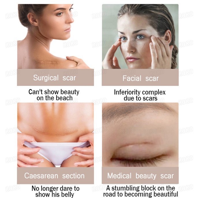 Dermatix Ultra Advanced Scar Formula Gel Cream Salep Penghilang Bekas Luka / Keloid ANTI SCAR Cream Krim Digigit Serangga Nyamuk Luka Bakar Stretchmark Stretch Mark 15gr Operasi Oprasi Iris Tergores Jerawat Gatal Hitam Ampuh