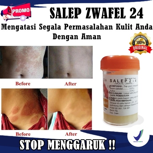 Obat gatal di leher salep zwafel 24 ori paling ampuh salep untuk eksim kulit kering menahun BPOM