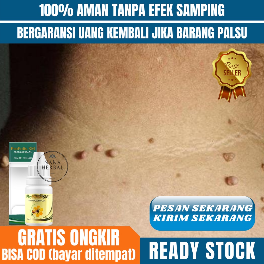 Obat Papilloma / Kutil, Obat Perontok Kutil di Leher, Obat Penghilang Papiloma di Tangan di Leher, O