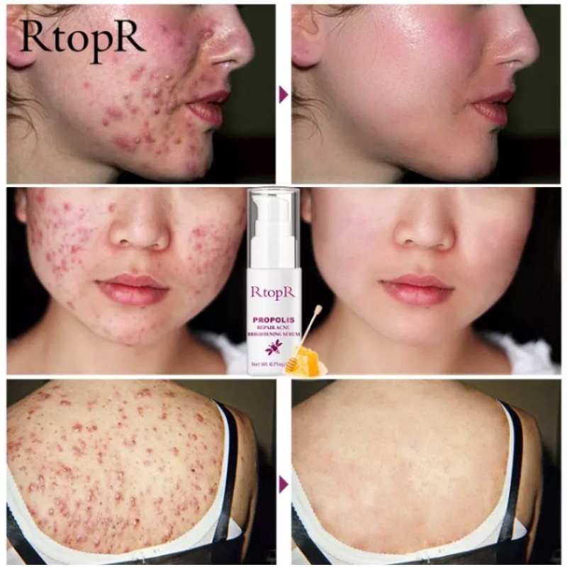 RtopR PROPOLIS REPAIR ACNE BRIGHTENING SERUM