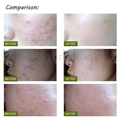 LAIKOU Pen LED Biru Laser Penghilang Jerawat Blue Light Acne Treatment - KD-7910 - White