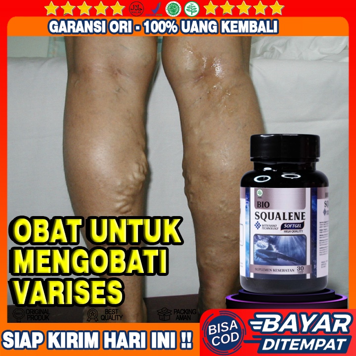Obat Verises - Obat Varises Di Kaki - Obat Varises Di Betis - Obat Varises Di Betis Kaki  - Obat Ura
