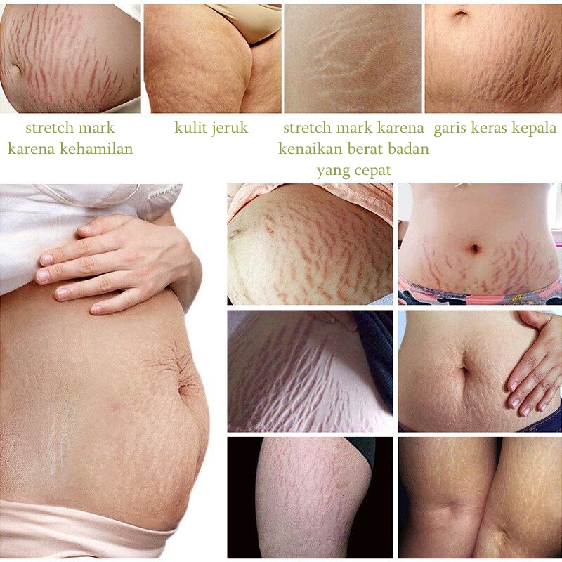 Stretch mark cream Krim Penghilang bekas luka  Krim Kehamilan Hilangkan stretch mark Obat Penghilang Strechmark Paling Ampuh Untuk Ibu Hamil Setelah Melahirkan Mama's Choice