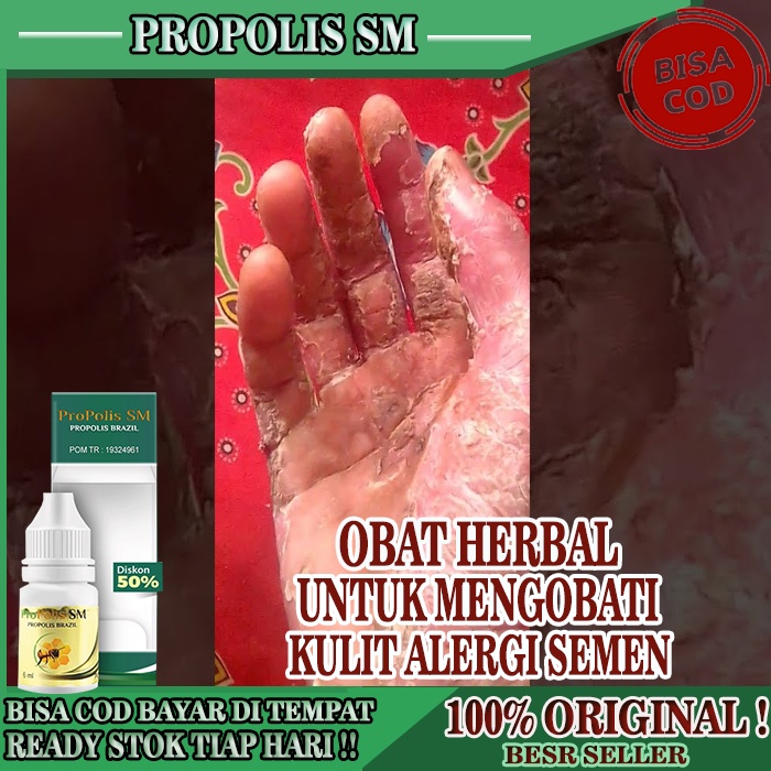 Obat Gatal Kulit Alergi Semen, Obat Gatal Alergi Pada Kulit, Obat Herbal Untuk Alergi Kena Semen, Ob