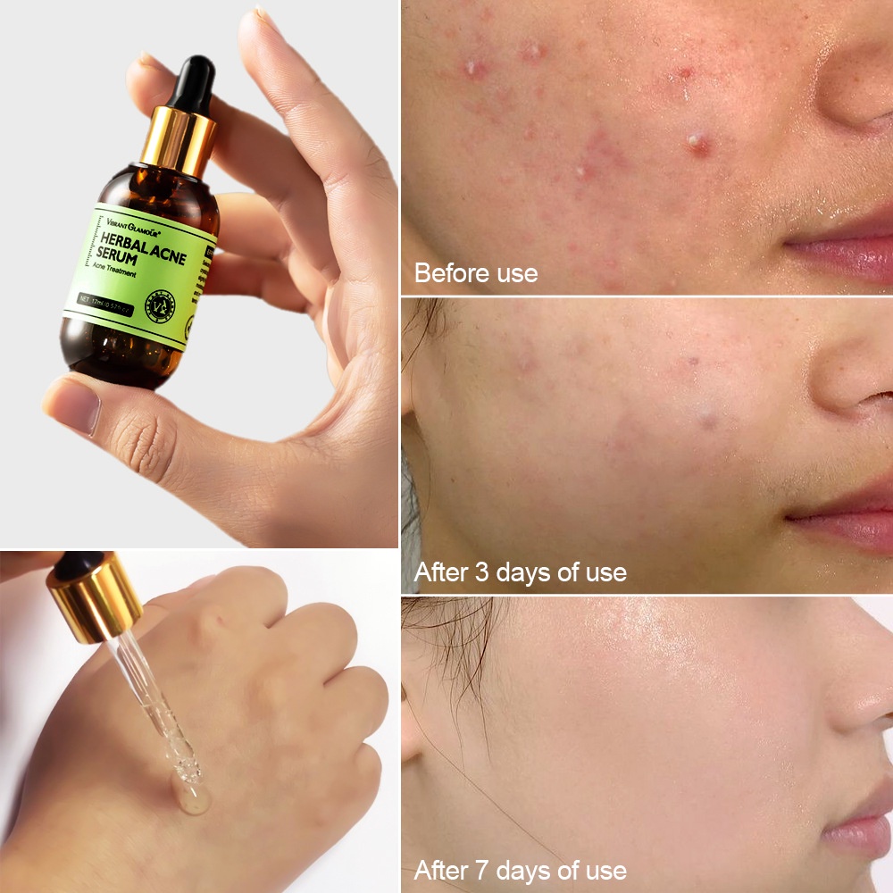 VIBRANT GLAMOUR Herbal Acne Treatment Cream / Acne Treatment Serum-Krim Perawatan Jerawat Tea Tree Oil penghilang jerawat Menghilangkan Pimple Dan Mengencangkan Pori-pori Kulit Berminyak Kulit Berjerawat