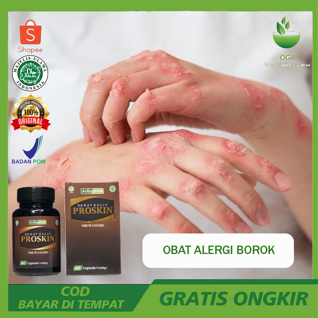 Obat Alergi Borok Gatal Eksim Panu Tradisional Menghilangkan Penyakit Kulit Jamur Eksem Kudis Kurap 