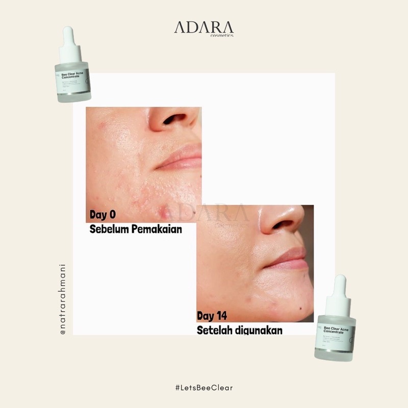 ADARA Bee Clear Acne Concentrate Serum 20ml (Bee Venom + TR Salicylic Acid + 3HA Serum)