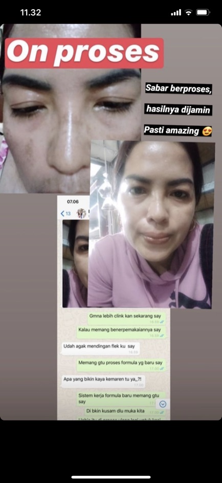 Lskin Platinum 1+  Paket Skin Care Perawatan Wajah Menghilangkan Jerawat Dan Pemutih Wajah-6