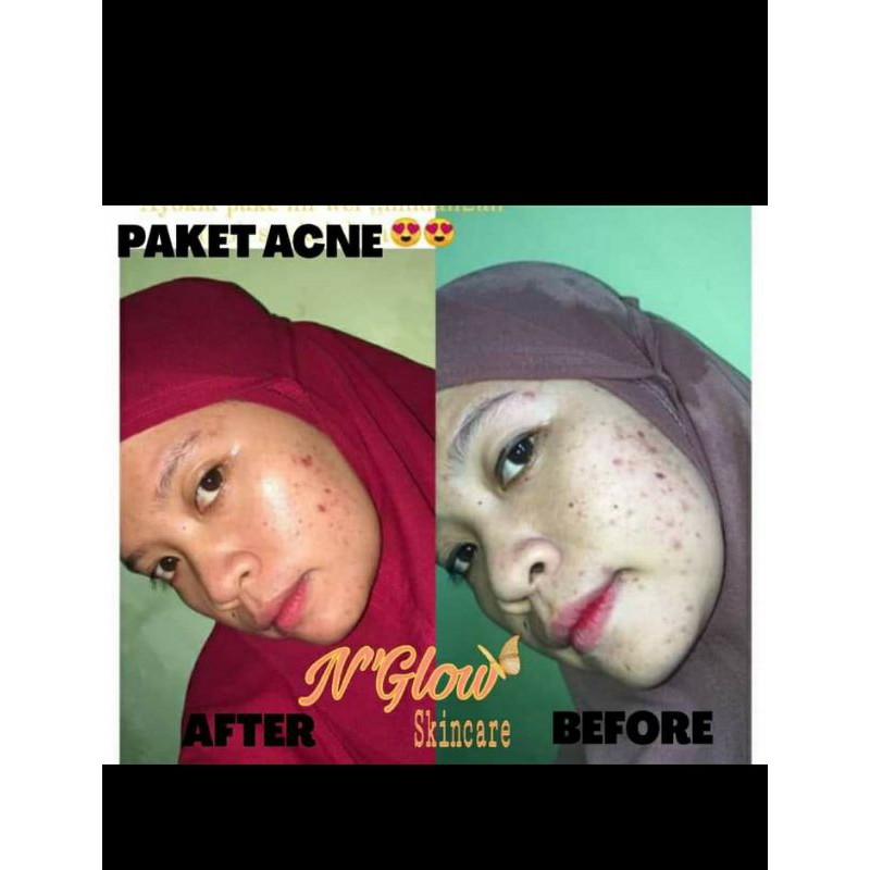 N'glow skincare[Acne]