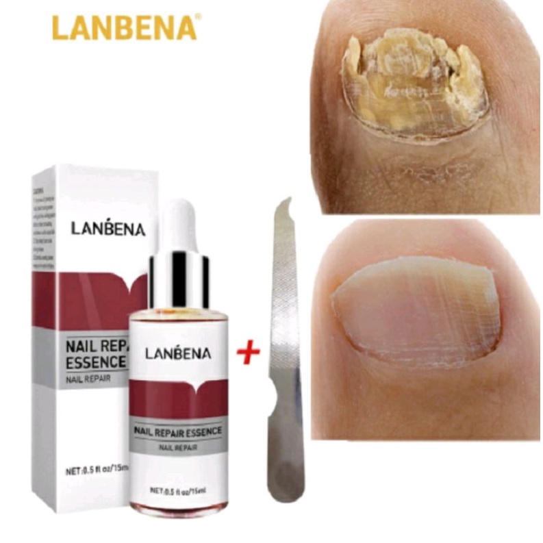 PENGHILANG JAMUR KUKU LANBENA SERUM