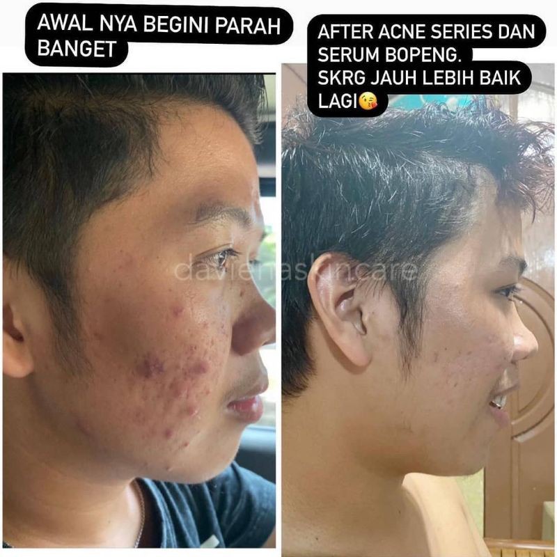 [Official] ACNE SERIES|CREAM JERAWAT AMPUH BPOM DAVIENA SKINCARE|Daviena Skincare