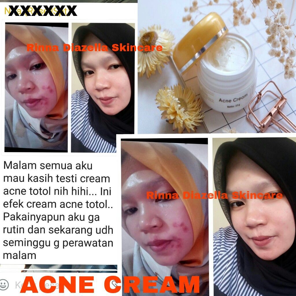 ACNE CREAM / CREAM JERAWAT / FLEK RINNA DIAZELLA - CREAM ACNE RD