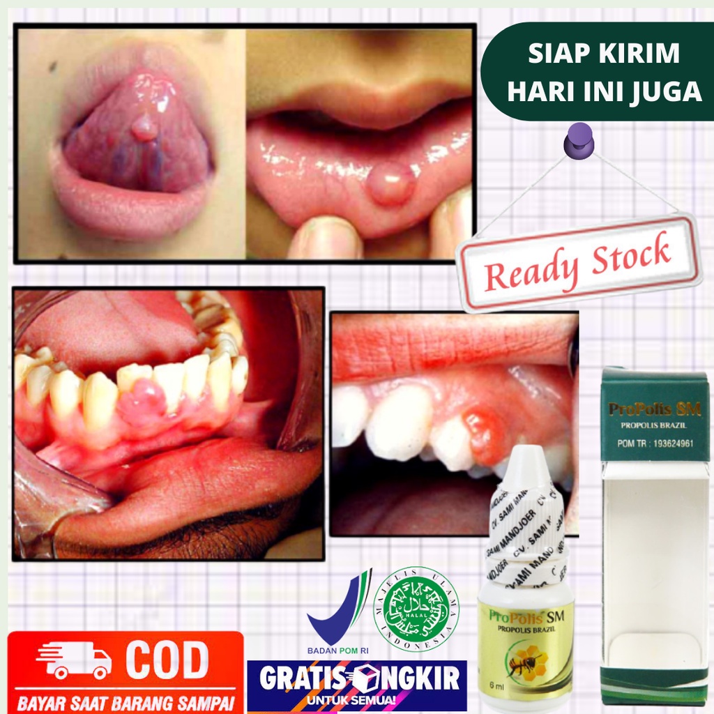 obat benjolan - obat kista - Obat Herbal - Benjolan lidah - Benjolan di Bawah Lidah - Obat Tetes Ben