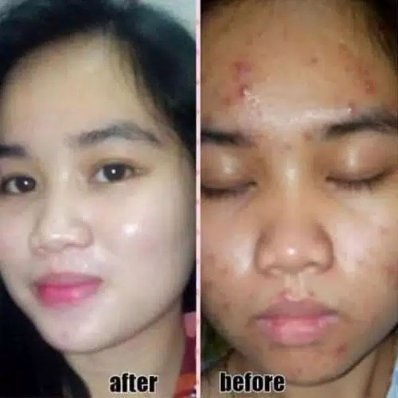 MASKER CHITIN CHITOSAN SOLUSI KULIT BOPENG, BERJERAWAT DAN PENGHILANG FLEK HITAM-5