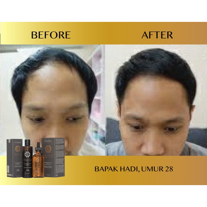 RAMBUT-VITAMIN-SUPLEMEN- FOLIGROU HAIR TONIC DAN SHAMPOO PENUMBUH RAMBUT -SUPLEMEN-VITAMIN-RAMBUT.