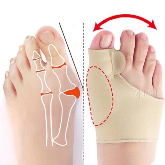 Original [Alat Terapi] Sleeve Korektor Tulang Jempol Bunion Hallux Valgus Orthotics Exp Baru