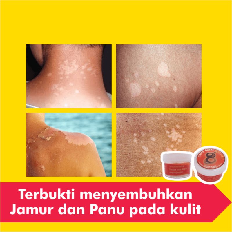 Obat Salep Panu Paling Ampuh Gatal Kurap Kutu Air Jamur Kulit Selangkangan Gatel Eksim Jerawat Kudis-3