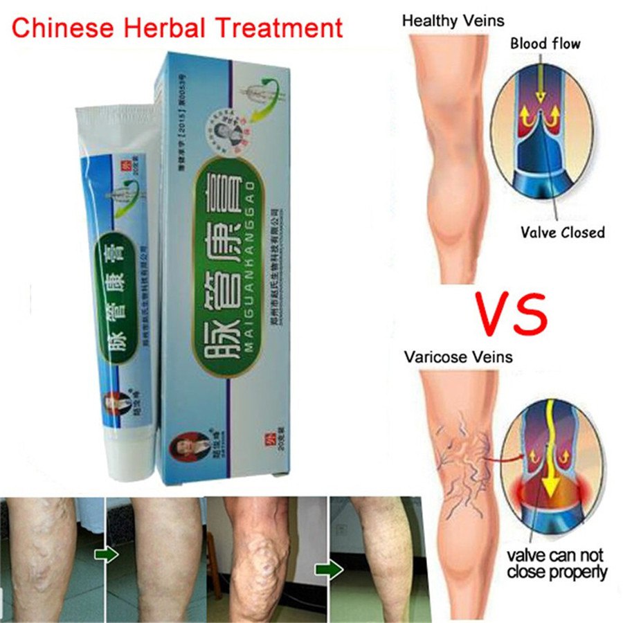 Salep Krim Varises Herbal Maiguankanggao - Varicose Veins Treatment