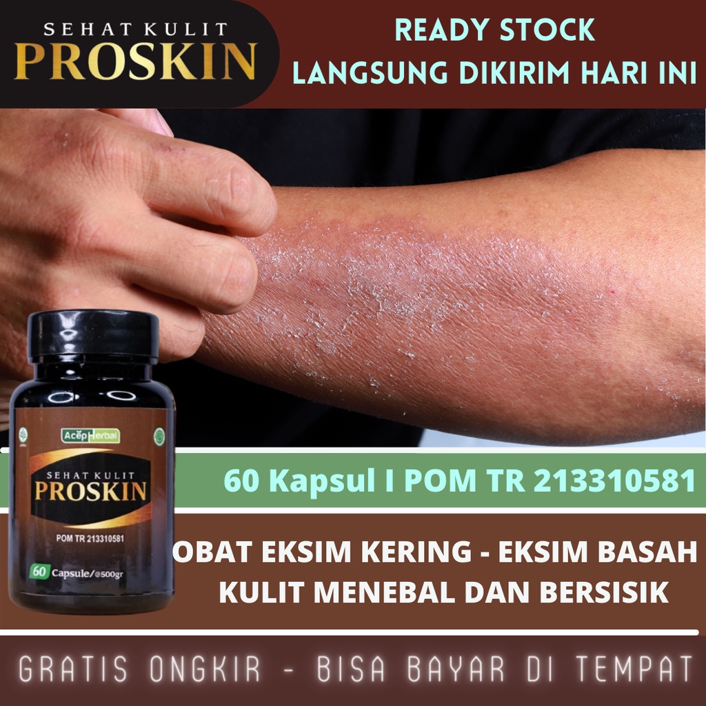 Obat Gatal Exim Kering Menahun, Obat Eksim Kering Basah, Obat Penghilang Gatel, Obat Kulit Kering Menebal, Obat Gatal Bersisik, Obat Eksim Bernanah di Kepala dan Telapak Tangan, Obat Eksim Kulit, Obat Kulit Gatal, Obat Jamur Selangkangan Dengan ProSkin