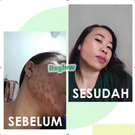 REGLOW CREAM KRIM CREM REJUVENATING INTENSIVE CREAM WAJAH KRIM PENGHILANG JERAWAT ORIGINAL 100% BPOM PENGHILANG BEKAS JERAWAT PENGHILANG FLEK HITAM