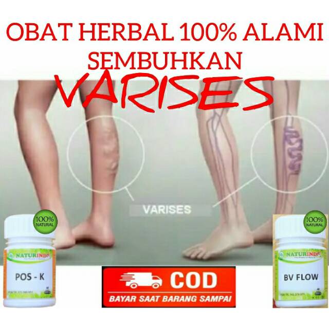 Obat Varises Parises Farises Urat melancarkan peredaran darah BV FLOW NATURINDO