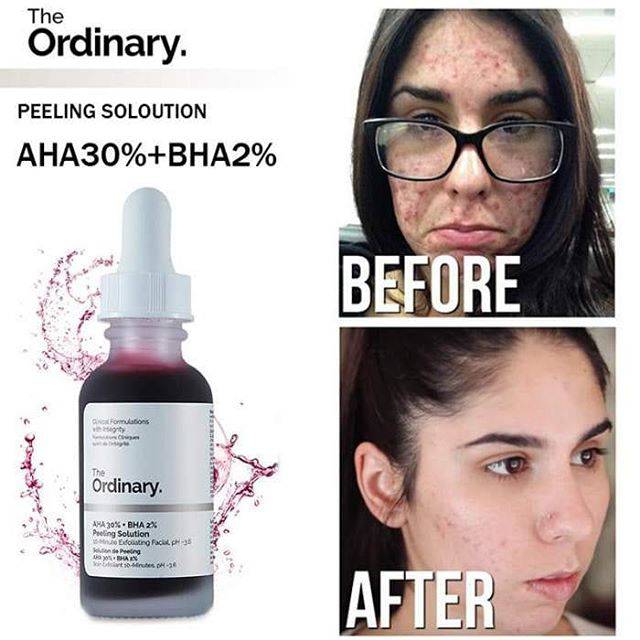 The Ordinary Peeling Solution