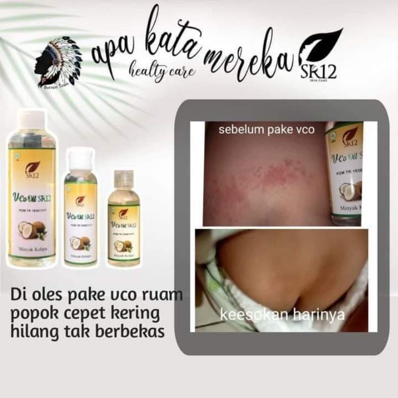 VCO SR12 MINYAK KELAPA UNTUK OBAT RUAM POPOK BAYI / Obat Biang Keringat / VCO VIRGIN COCONUT OIL / MINYAK KELAPA MURNI / VICO OIL SR12 / PENAMBAH IMUN TUBUH / SIAP NEW NORMAL