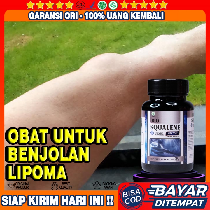 Obat Pengilang Benjolan Lipoma Di Tangan, Obat Pengempis Benjolan Lipoma Di Tangan, Obat Penghilang 