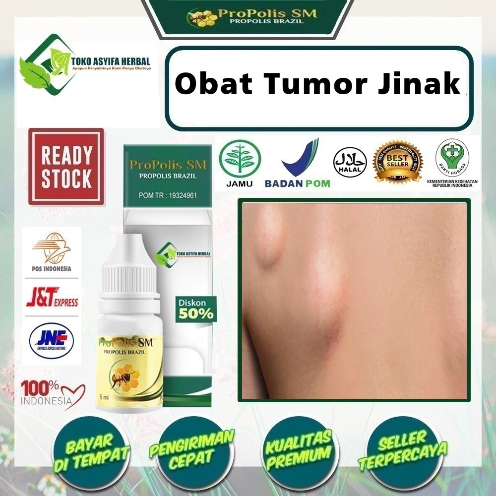 Obat Tumor Jinak, Tumor Ganas, Penghilang Benjolan Di Leher, Punggung, Kepala, Tangan, Telinga