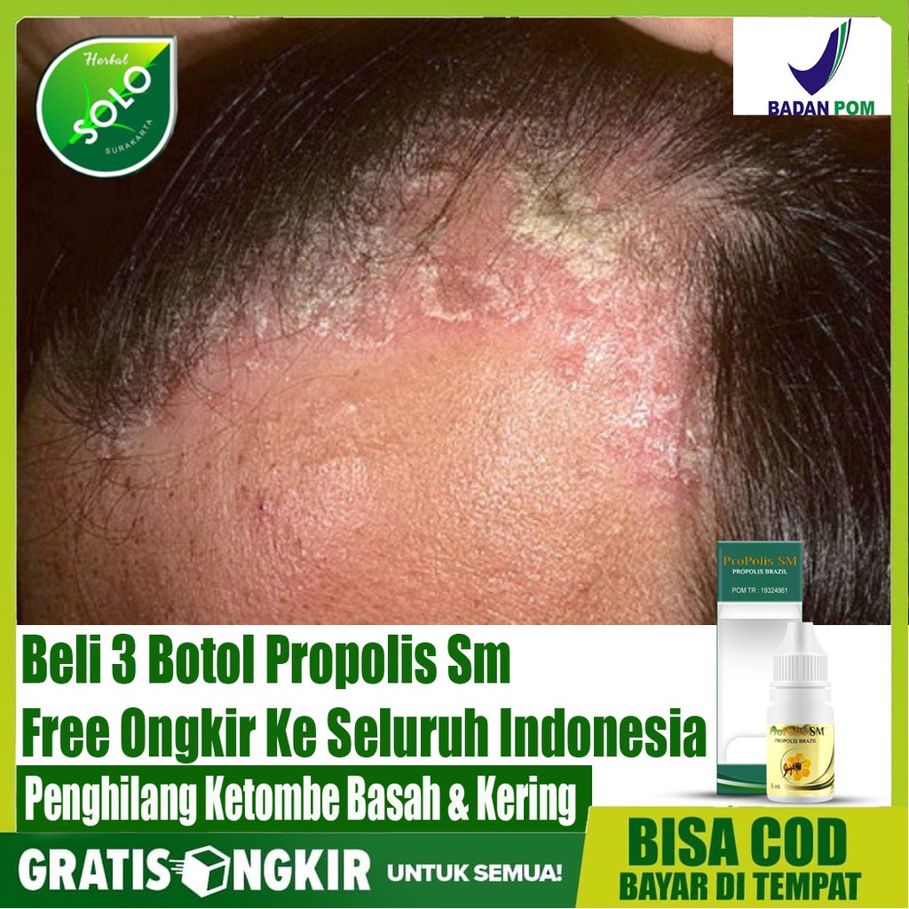 Obat Penghilang Ketombe Rambut, Ketombe Kering, Ketombe Basah, Gatal Ketombe Di Kepala - Propolis Sm